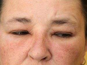 Close up image of swollen eyelids.