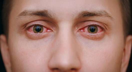Image of a girl with pink eye.