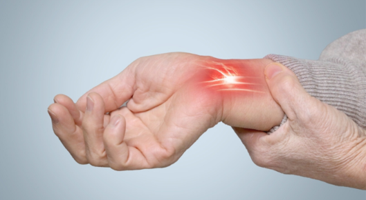 Woman with carpal tunnel syndrome.