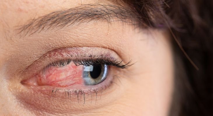 ocular rosacea