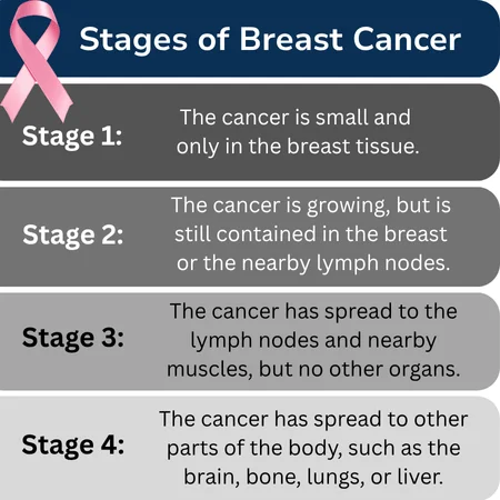 Four Stages of Breast Cancer Diagnoses A graphic showing the four stages of breast cancer diagnostics