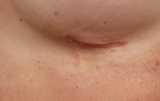 Mondor's cord, breast augmentation, breast implants, plastic surgery, breasts