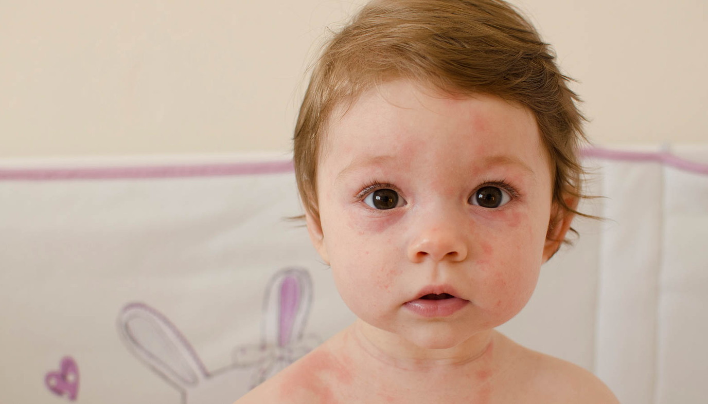 child with heat rash