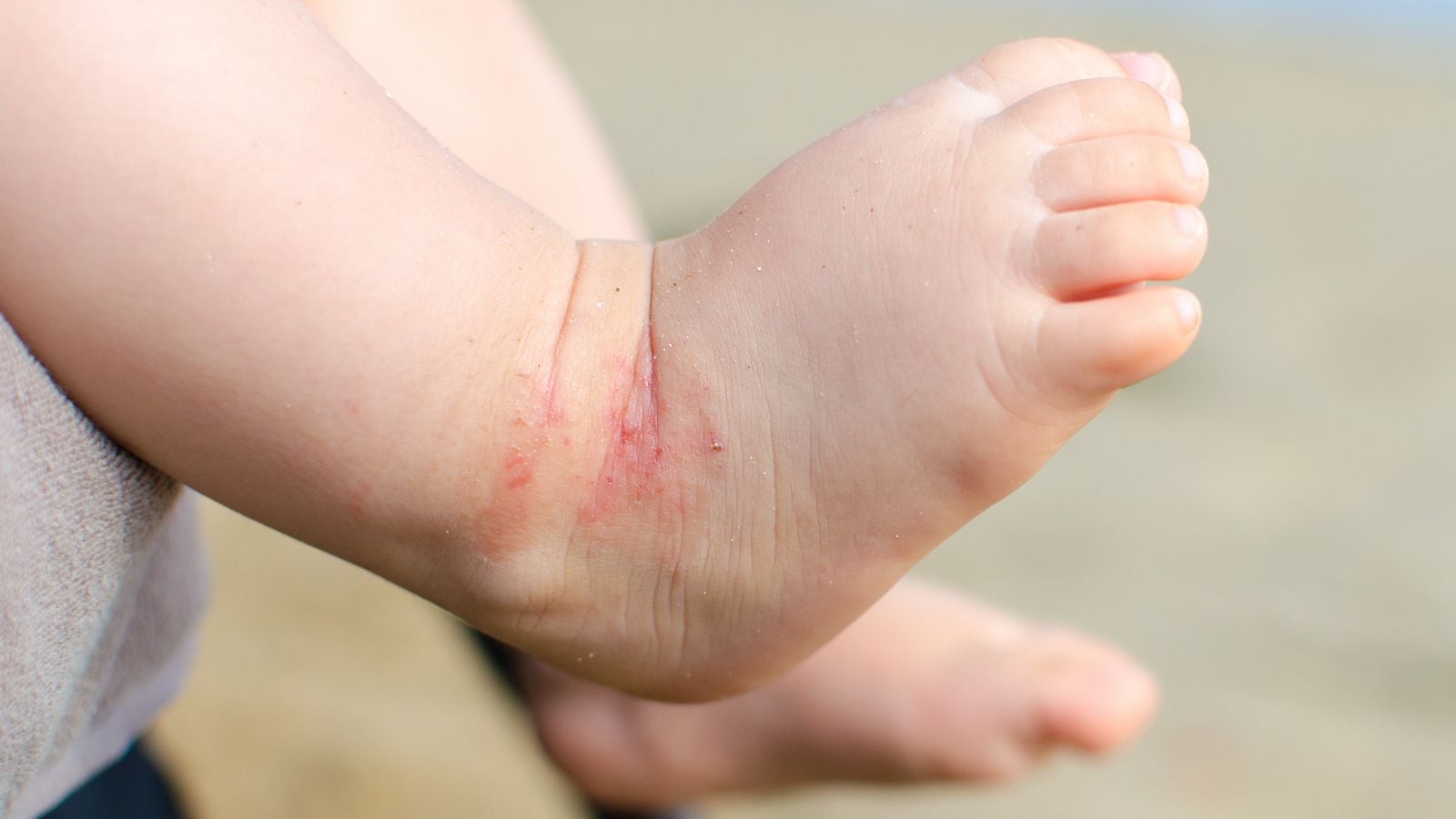 foot rash
