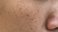freckles on face
