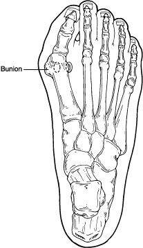 Bunion Bunion