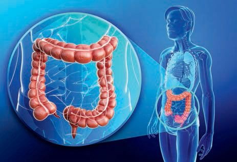 Understanding Colon Polyps and Their Treatment - Gastroenterologist ...