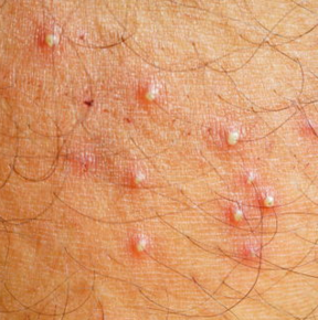 Folliculitis