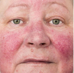 Rosacea