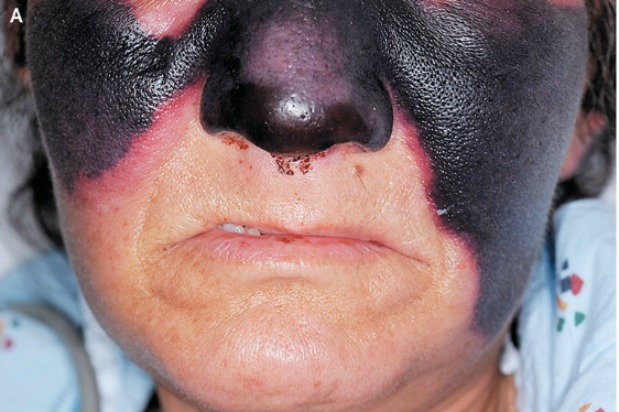 woman's face with levimisole poisoning
