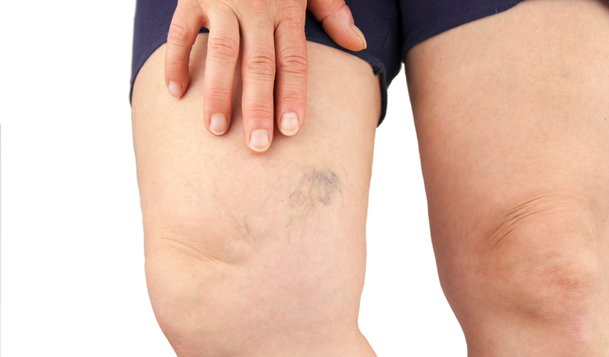 Spider Vein Guide: Causes, Prevention & Treatment