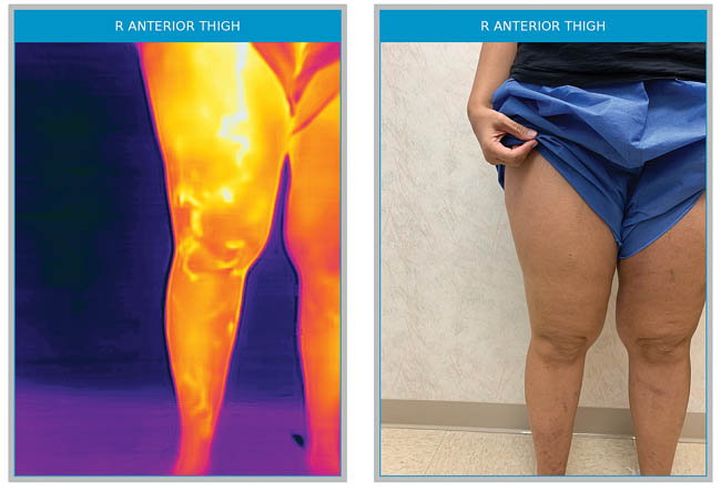 Right anterior accessory vein that connects all the way to the ankle, invisible to the naked eye, very symptomatic, missed by the original ultrasound mapping, but after thermography became very obvious to the technician.