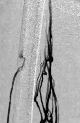 Figure 2. Pre-intervention venogram indicating significant femoral vein obstruction with multiple collaterals.