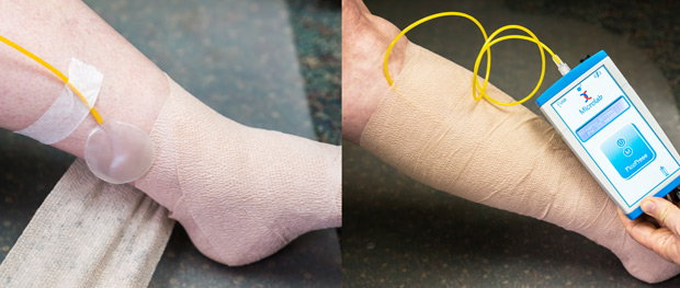 Figure 1. Use of tape or a second person is necessary in order to keep the Picopress sensor in the desirable position during bandaging.