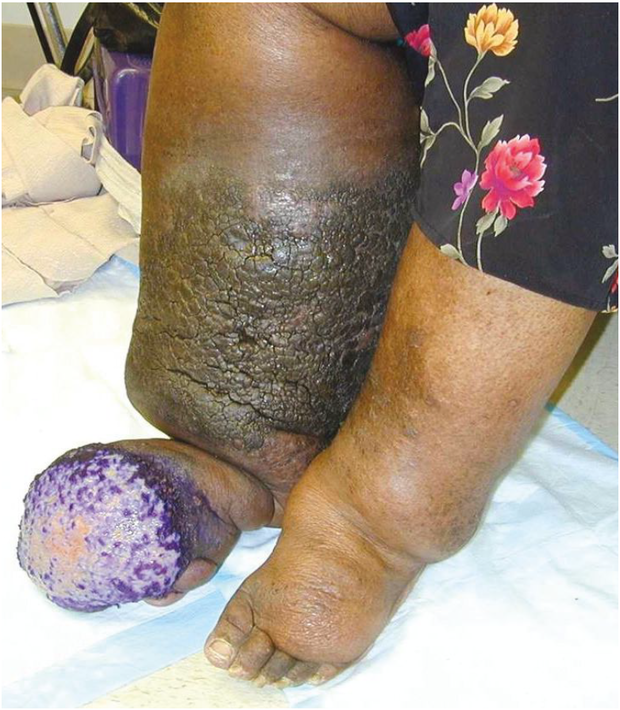 Patient with elephantitis nostras verrucosis
