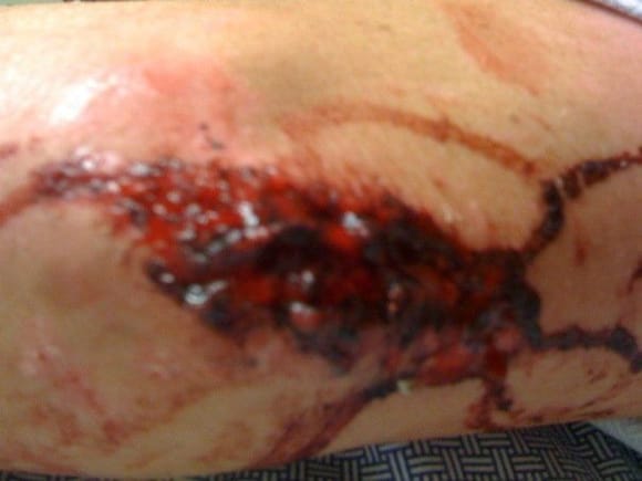 left elbow, before stitches