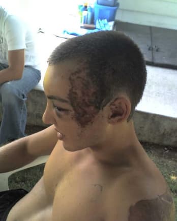 This is what happens when u dont wear a helmet